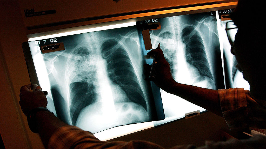 2 active tuberculosis cases traced to San Francisco strip club — KTVU FOX 2 Bay Area, Santa Cruz Health news